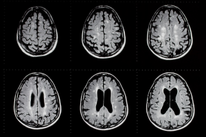 Th phases of a seizure