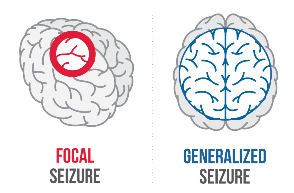 The types of Seizures