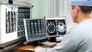 Epilepsy Treatments and Surgeries 